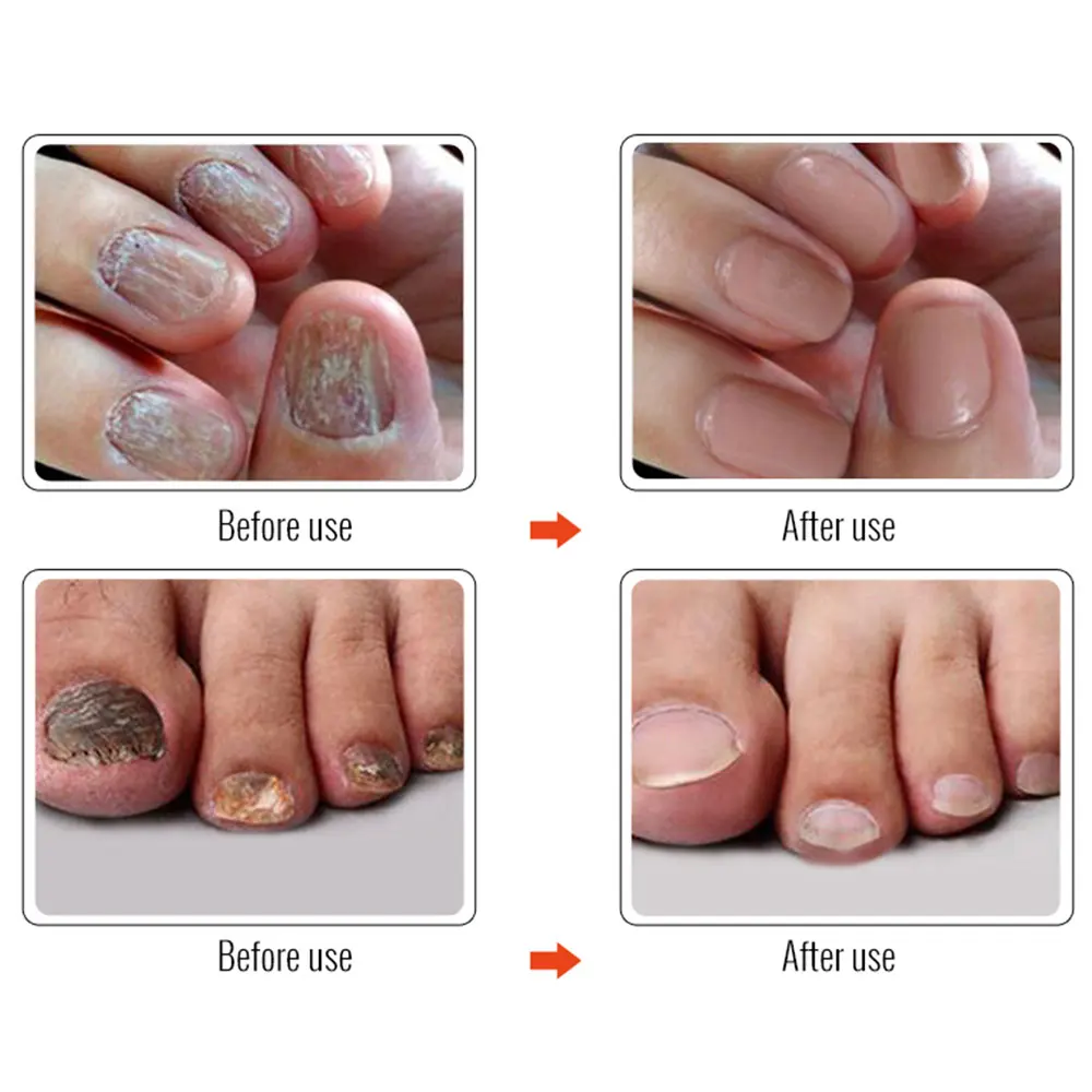 Красота Onychomycosis жидкость для восстановления ногтей 10 мл эффективный набор