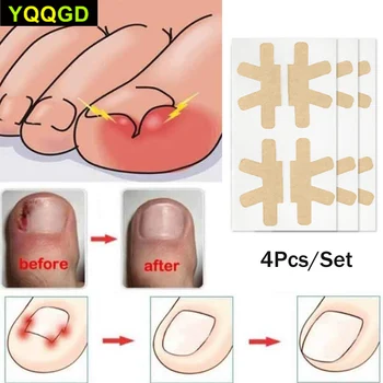 

4Pcs/Set Toe Nail Care Pedicure Tools Toenail Corrector Stickers Curved Brace Straightening Clip Toenails Thick Paronychia