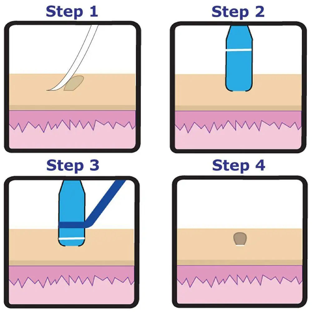 Medical Skin Tag Kill Skin Mole Wart Remover Micro Band Skin Tag Removal Kit With Cleansing Swabs Adult Mole Wart Face Care tool Medical Skin Tag Kill Skin Mole Wart Remover Micro Band Skin Tag Removal Kit With Cleansing Swabs Adult Mole Wart Face Care tool