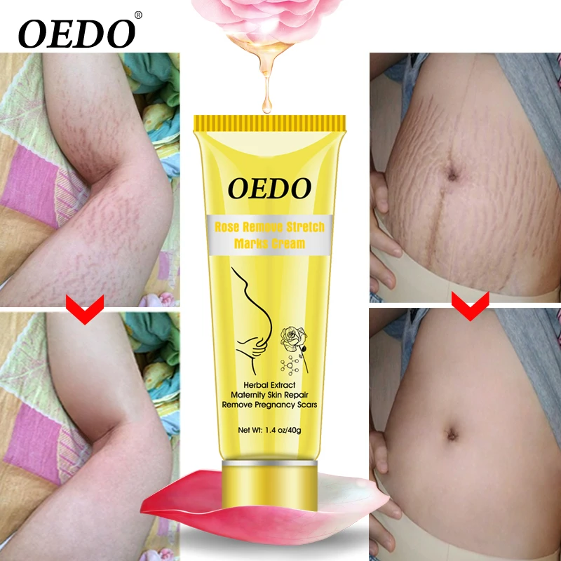 

OEDO Rose Remove Stretch Mark Cream Nourish Moisturizing Anti-wrinkle Pregnant Women Skin Repair Remove Obesity Tattoo Body Care