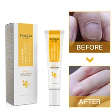 Уход за ногтями, крем для восстановления ногтей, Лечение грибка, удаление онихомикоза, против грибок ногтей, крем для восстановления пальцев ног, крем для защиты ногтей