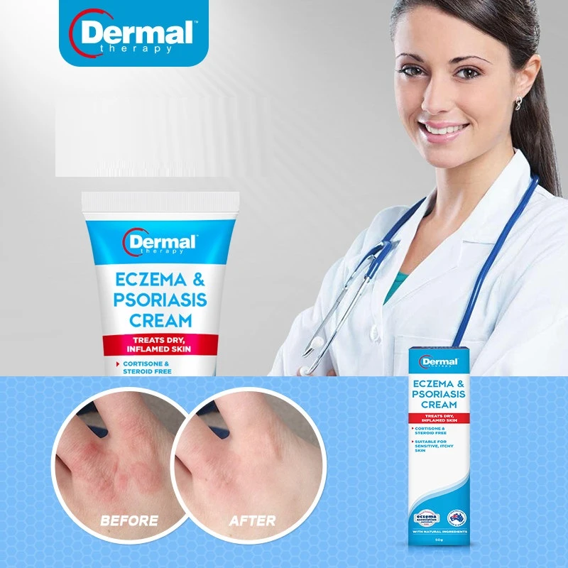 steroid cream for psoriasis prescription