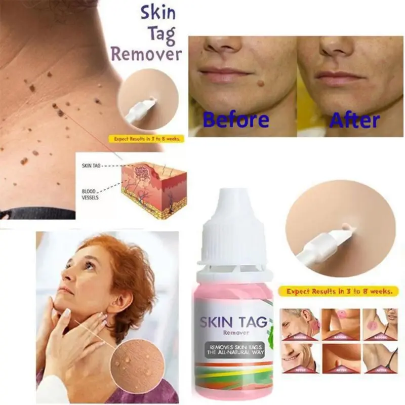 10ml Skin Tag Remover Liquid Natural Plant Extract Foot Corn Plantar Body Warts Chinese Medicine Treatment Ointment | Красота и