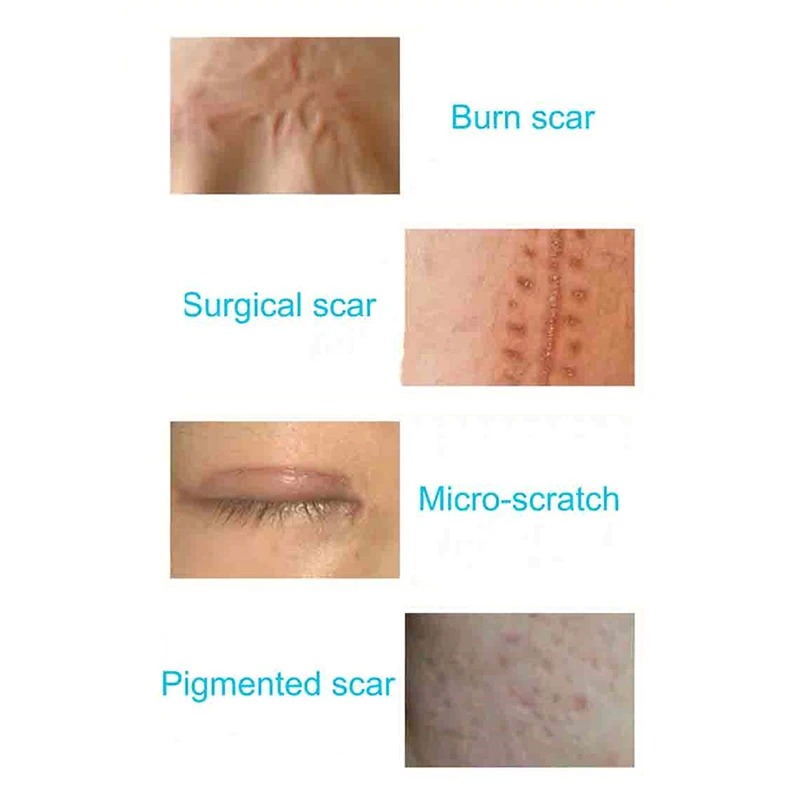 15 г лечение шрамов крем для лица против акне удаление растяжек крем, обеспечивающая гладкость кожи естественного обновления заживление кожи для ремонта