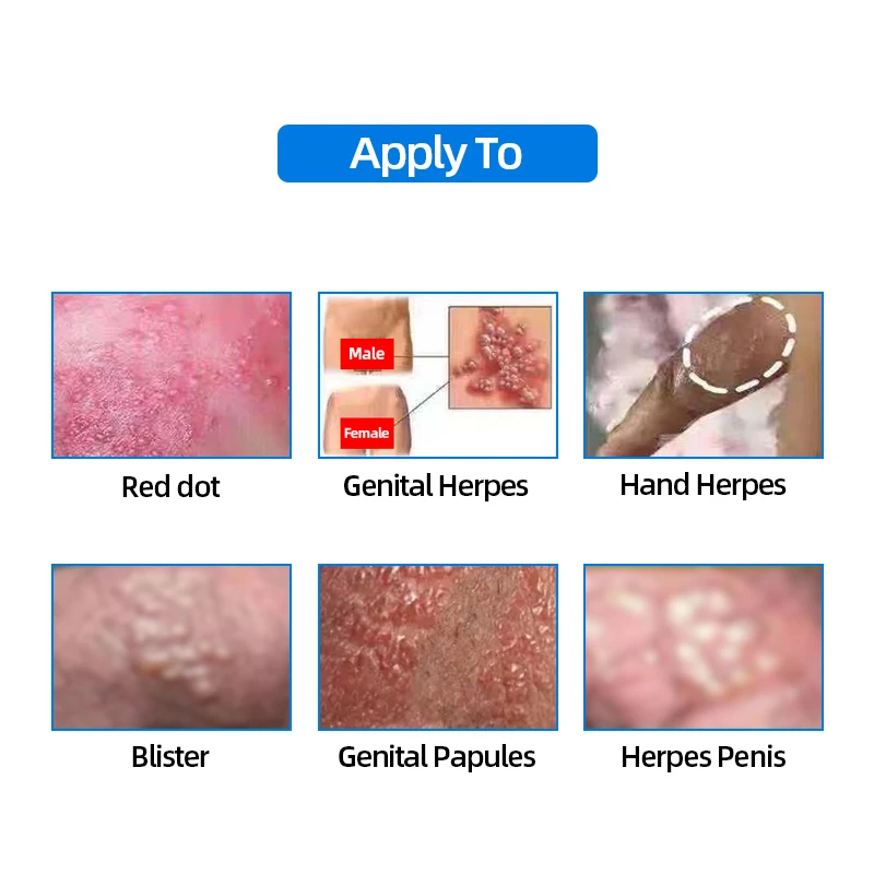 Female papules