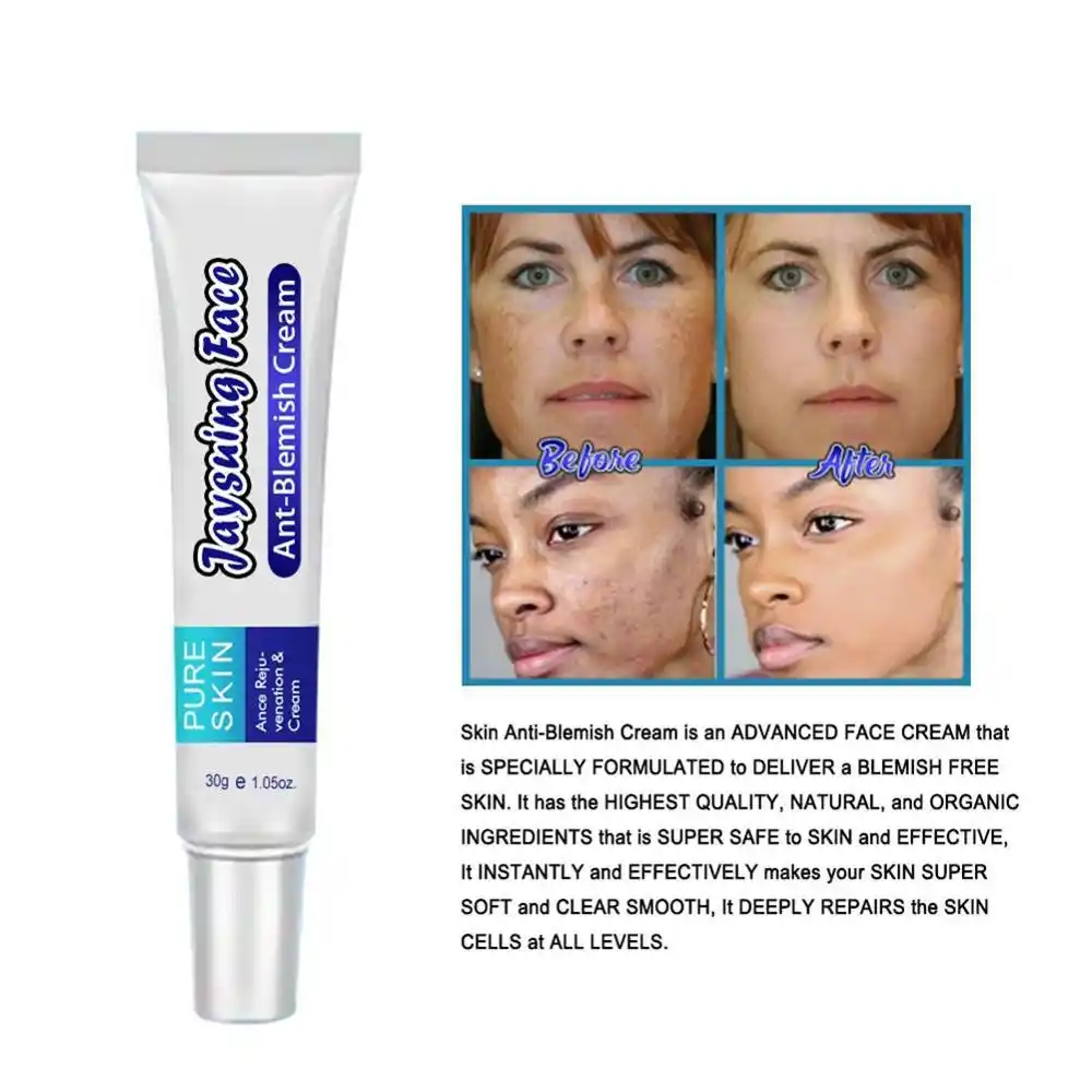 topical cream for stretch marks