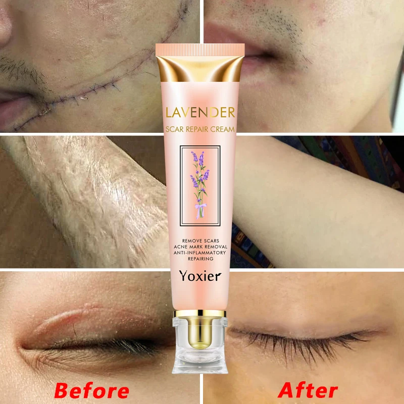 

20g Remover Acne Scar Stretch Cream Marks Repair Acne Spots Acne Treatment Face Cream Blackhead Skin Care Whitening Cream