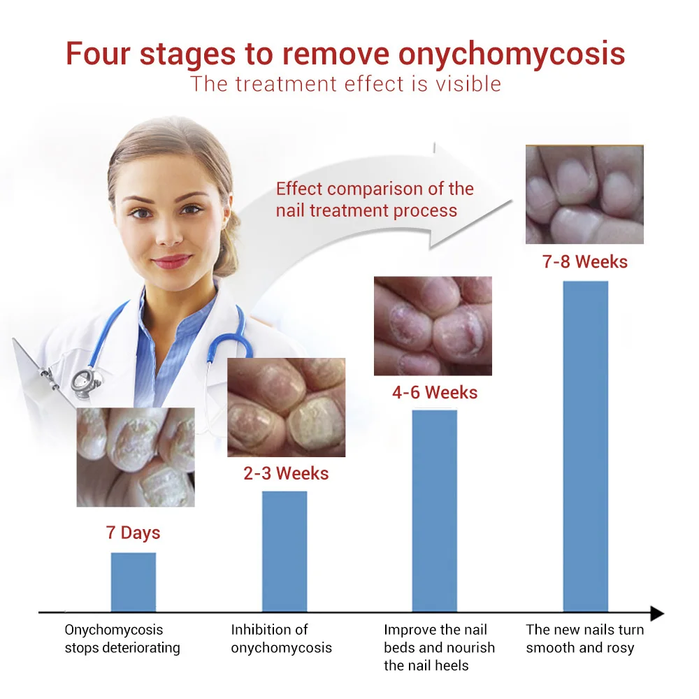 Fungal Nail Repair Essence Serum Care Treatment Foot Nail Fungus Removal Gel Anti Infection Paronychia Onychomycosis