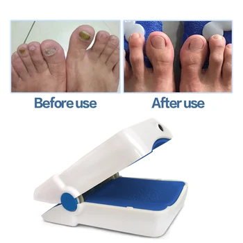 

Nail Fungus Remover Treatment Revolutionary Laser Device, For Home Use, Safe, Quick, Painless Therapy Treatment For Toes And Fin