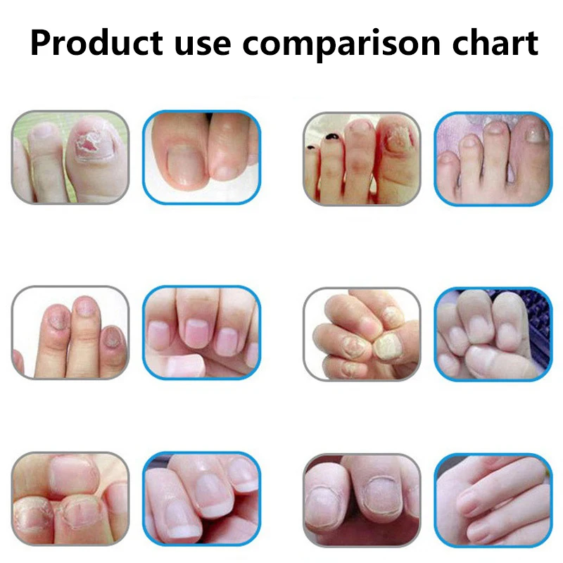 Nail Repair Tools Efficient Fungal Nail Treatment Anti Fungal Nail Infection Cream Onychomycosis Paronychia Chinese Herbal Care