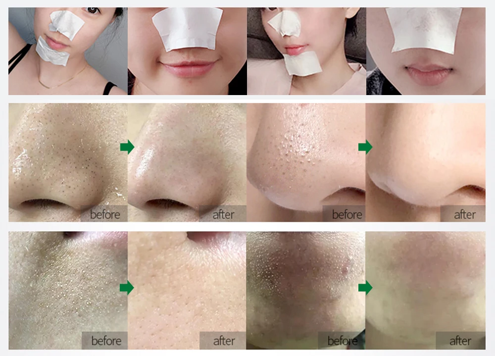 Breylee Blackhead Mask And Pore Minimizer Serum ( 17Ml +17 Ml ) H8D69Ca274Bd34C3895D9Bb7Ddb7575Bc3