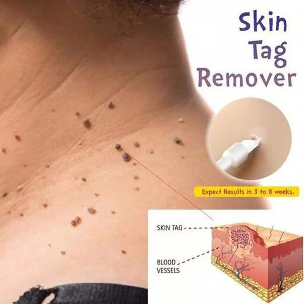 Body Skin Care Medical Tag Kill Mole Wart Remover Effective 10ml | Красота и здоровье