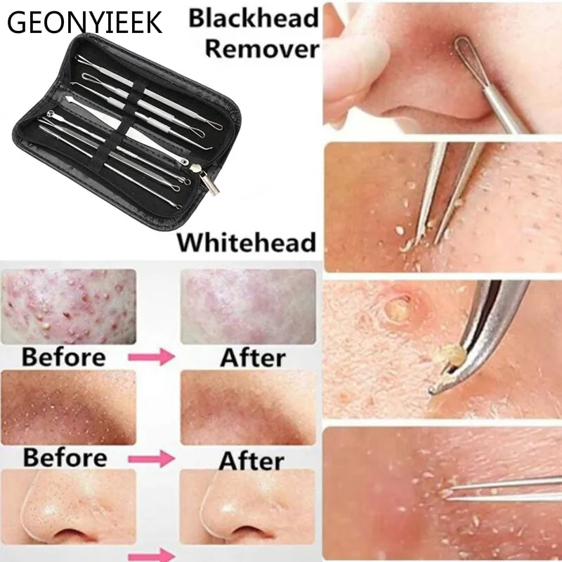 3 4 5 7 8 Pc Stainless Steel Blackhead Remover Tool Kit Face Massage Whitehead Pimple Spot Comedone Acne Extractor Face Massager