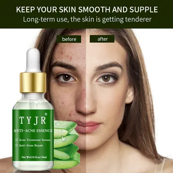 

10ML Face Care Acne Scar Removal Essence Serum Acne Spots Skin Care Treatment Whitening Remove Acne Face Serums Care