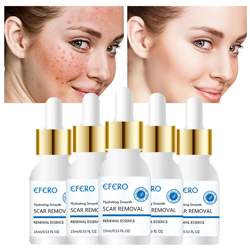 

Anti Acne Essence Pimple Scar Remover Moisturizing Whitening Skin Care Acne Shrink Pores Face Cream Acne Treatment Face Serum