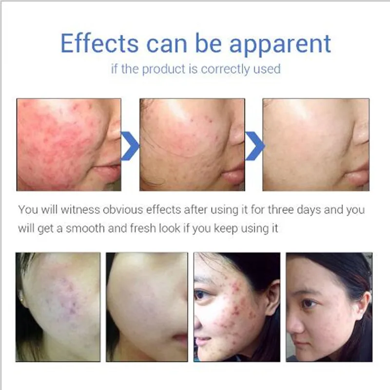 LANBENA Acne Cream For Face Acne Pimples Removal Fade Acne Pimples Marks Skin Care Repair Gel 4