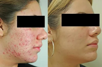 

R A Cream 0.05% 10g/20g