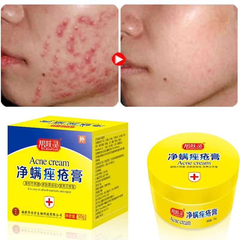 expensive acne cream