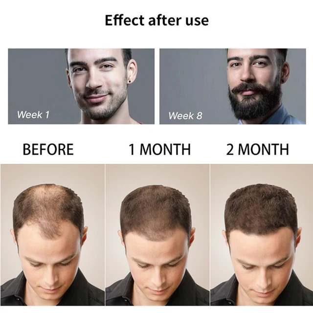 DRS 540 Dermaroller Men Beard Growth Derma Roller Men's Hair growth Nourishing Anti Hair Loss Black Microneedle roller 4