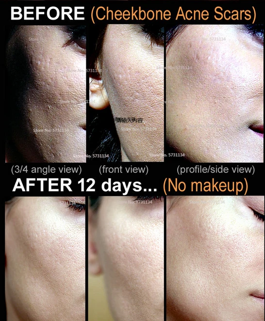 boxcar scars cream