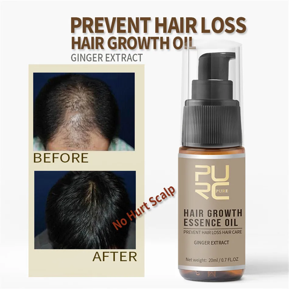 PURC эссенция для быстрого роста волос масло для лечения выпадения волос помощь для роста волос уход за волосами 20 мл средство от выпадения волос для истончения волос