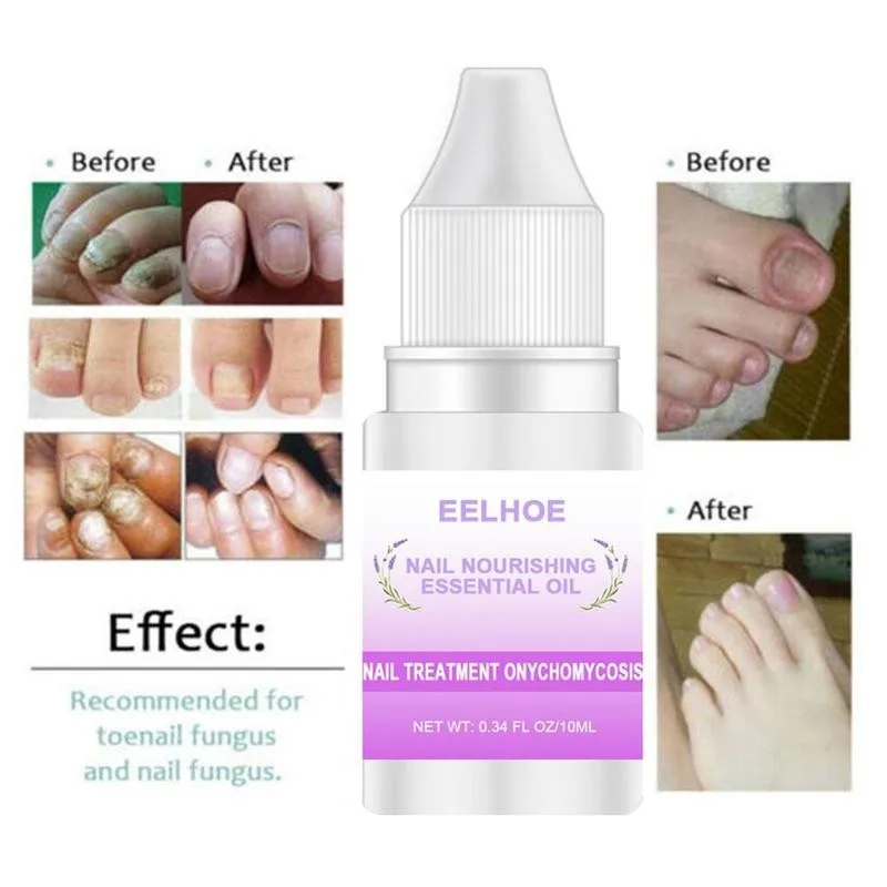 1 шт. не маркировочный крем для удаления моль Лечение ногтей защита 10 мл артефакт