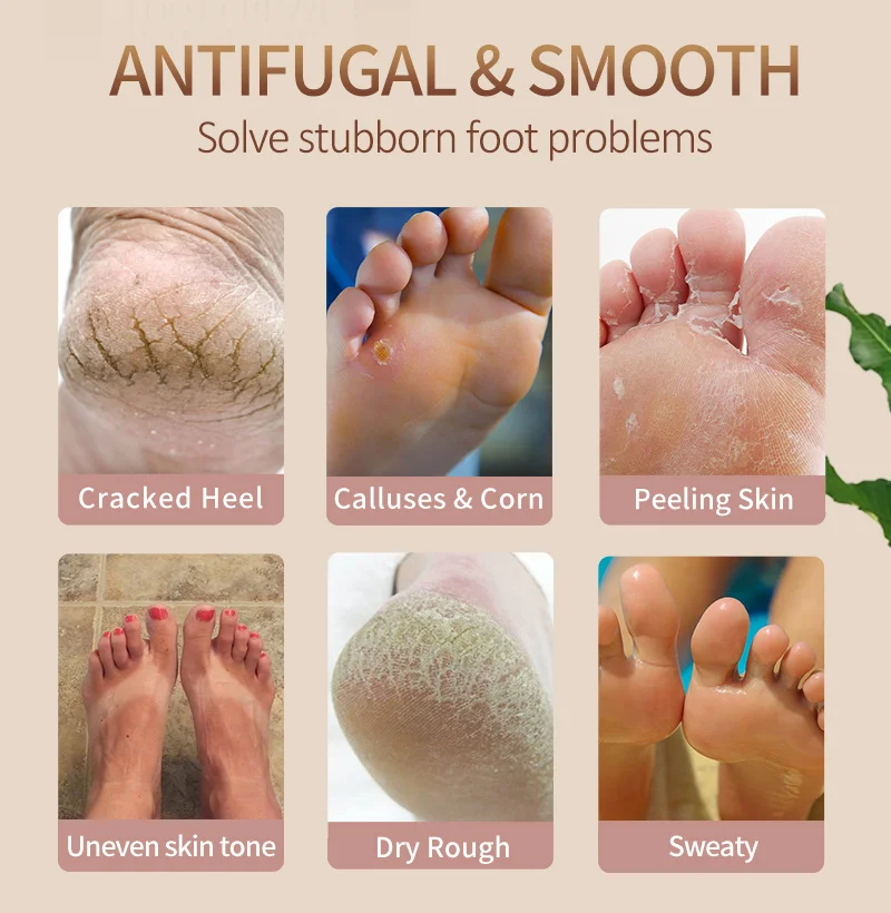 Anti Fungal Foot Repair Foot Cream Dead Skin Removal Peeling
