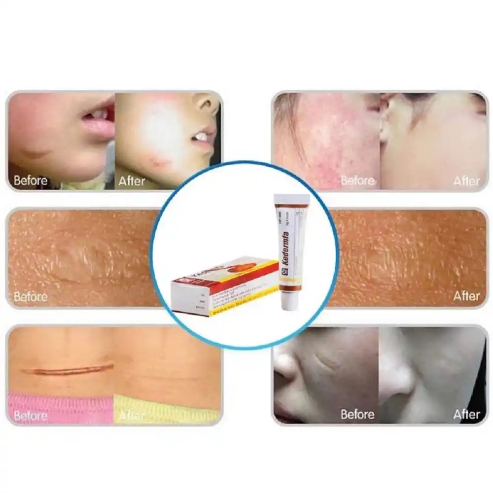 black skin scar removal cream