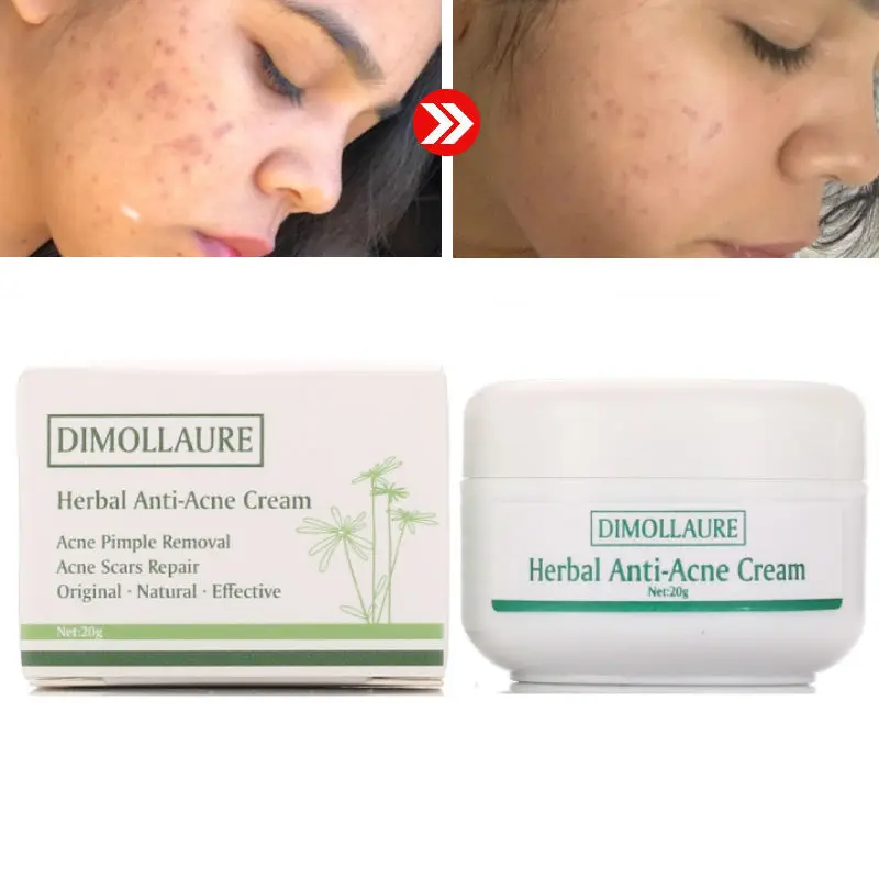 remove acne cream