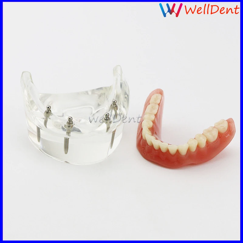 Modelo de Demonstração Modelo de Estudo Dentes Dentários Modelo Overdenture Inferior 4 Implante Dente Laboratório Dental 1pc 2 1pc dentes dentários modelo overdenture inferior 4