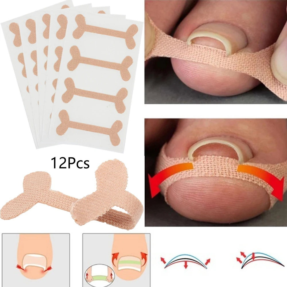 ingrown toenails band Aid relief pain Paronychia correction pedicure