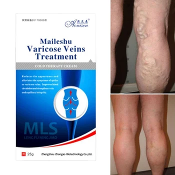 

Cold Therapy Cream For Varicose Veins Treatment Leg Gel For Discomfortcaused By Varicose Veins