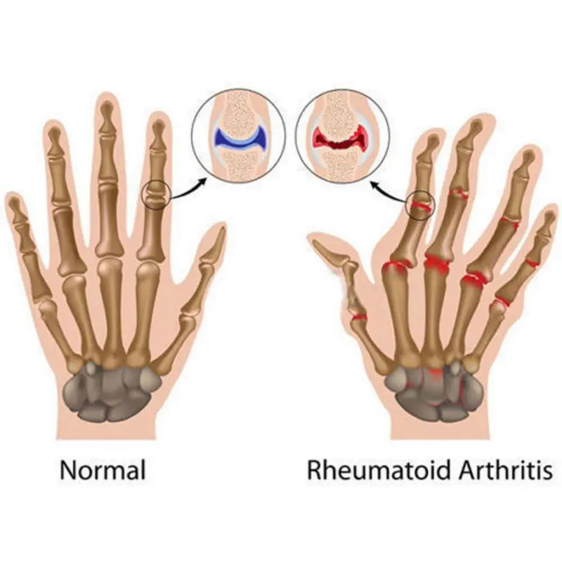 Перчатки при артрите терапевтические компрессионные перчатки для мужчин и женщин циркуляционный захват медные руки утяжелители