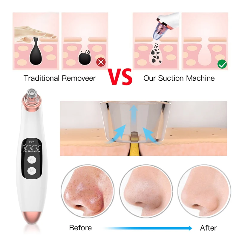 Electric-Vacuum-Suction-Blackhead-Remover-Black-Head-Pimple-Removal-Nose-Facial-Pore-Cleaner-Beauty-Face-Skin (4)