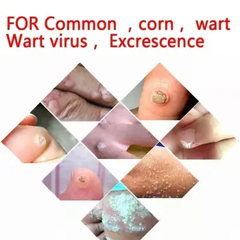 

Body Warts Treatment Cream Chinese Traditional Foot Patch Ointment Removal Warts Cream Foot Plantar Care Corn Genital T9F1