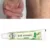 Dropshipping Zudaifu Skin Psoriasis Cream Дерматит Экзематоидная Экзема Мазь Лечение Псориаза Крем По Уходу За Кожей Крем
