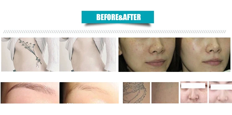 Antes e depois da remoção de tatuagem a laser