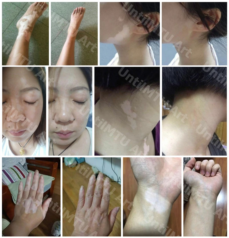 Vitiligo макияж водонепроницаемый мгновенные патчи для кожи покрытие лосьон карандаш для лица тела для женщин мужчин детей XISHENGYAN 5 шт