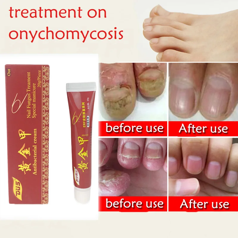 Лечение ногтей onychomicosis Paronychia анти грибковая инфекция ногтей хороший результат Китайский Травяной Уход за ногтями