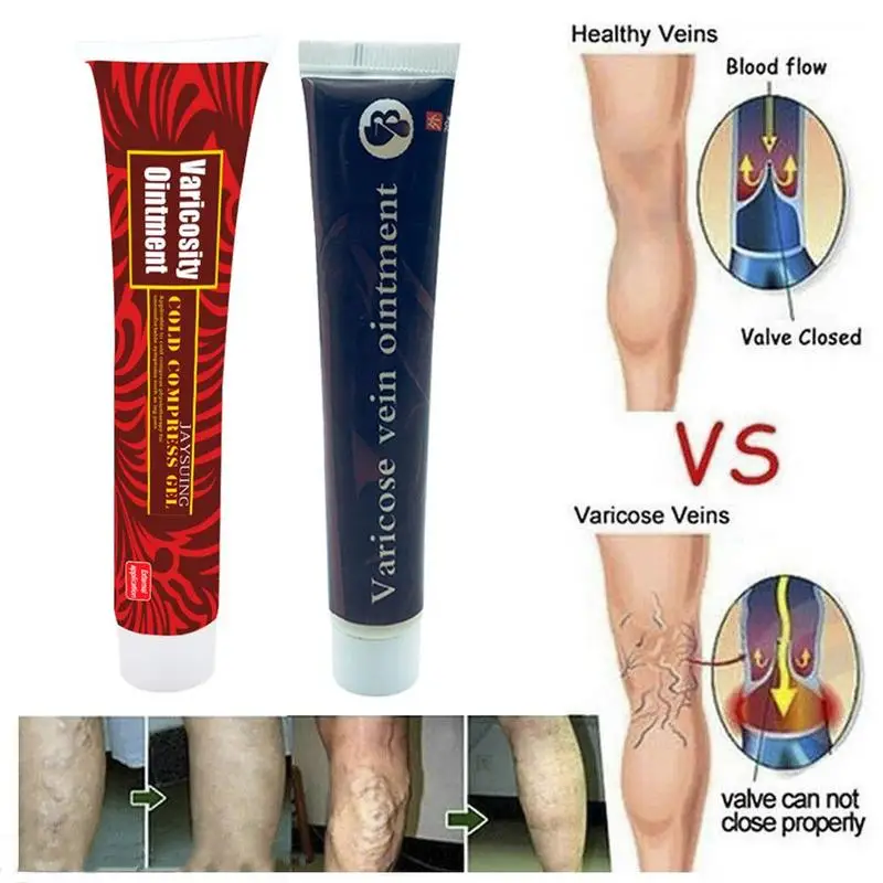 

1PC Varicose Veins Treatment Ointment Vasculitis Phlebitis Spider Veins Pain Varicosity Angiitis Remedy Removal Herbal Cream