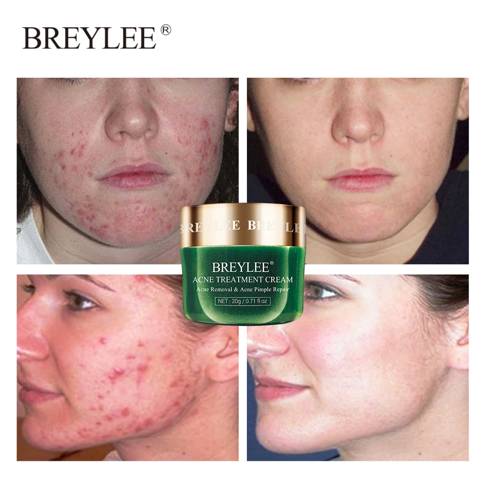 

BREYLEE Tea Tree Acne Treatment Face Cream Anti Acne Pimple Removal Spots Oil Control Shrink Pores Moisturizing Skin Care 20g