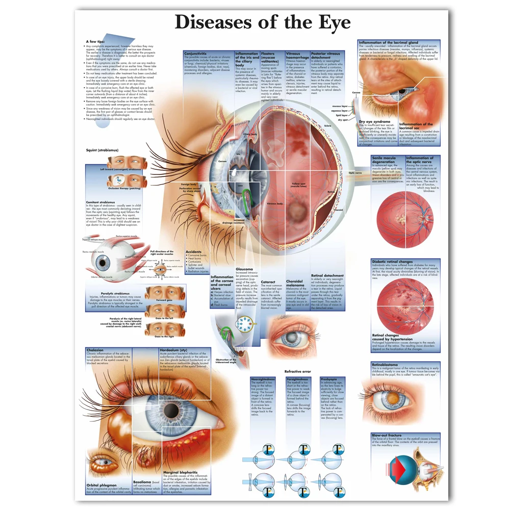 Online WANGART Poster Krankheiten der Eye Chart Poster Refractiv Leinwand druck Wand Bilder für Medizinische Bildung Wohnkultur