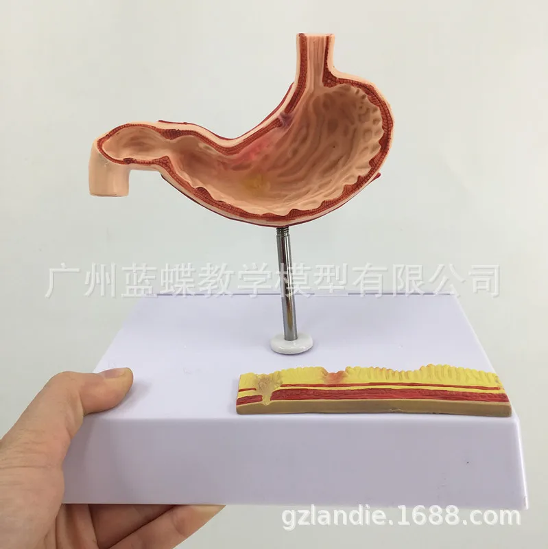 Human Stomach Lesions Model Have Base Medical Teaching Model Manufacturers Direct Selling