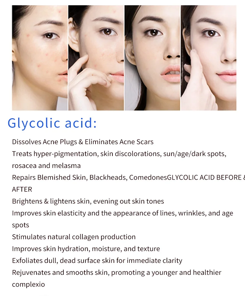 glycolic acid and rosacea