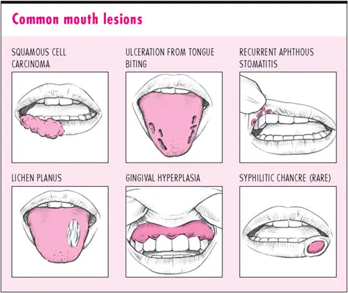 mouth-ulcers2