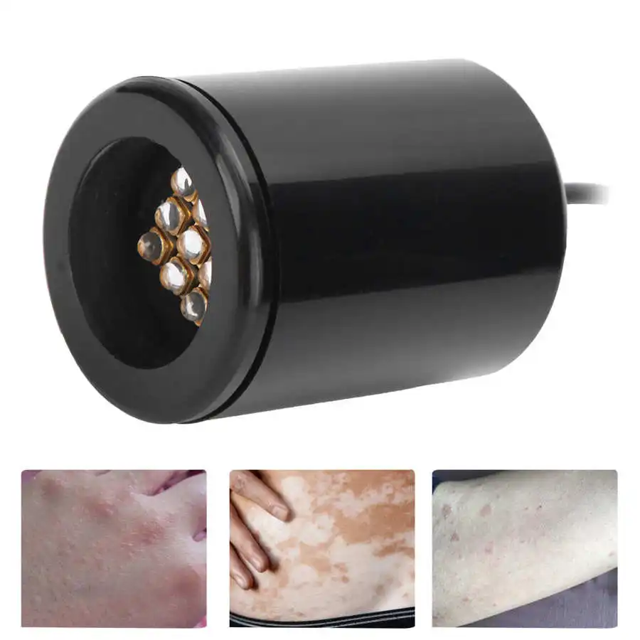 Vitiligo Physiotherapy Instrument 308 NM UV Light Lamp Psoriasis