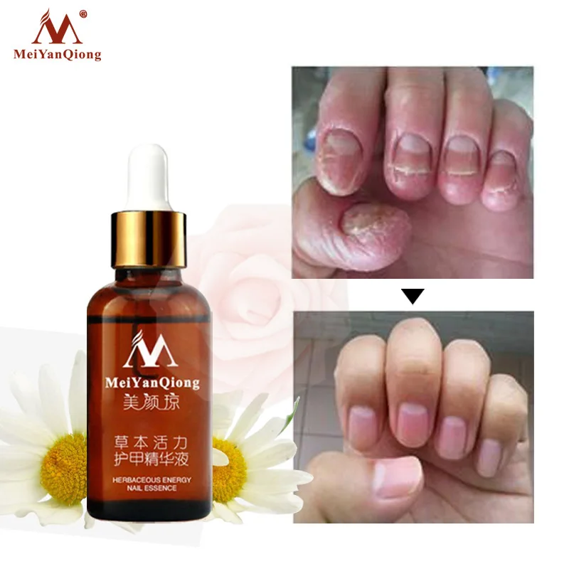 Fungal Nail Treatment Feet Care Essence Nail Foot Whitening Toe Nail Fungus Removal Gel Anti Infection Paronychia Onychomycosis