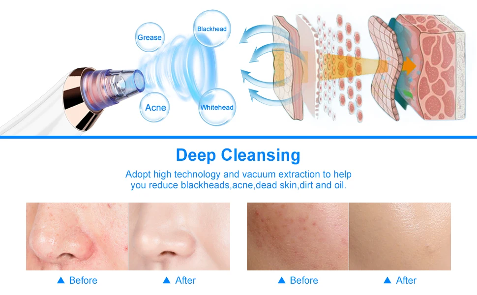 Blackhead Remover Pore Vacuum 2