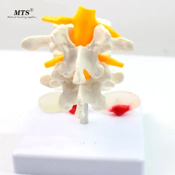 

Lumbar Lesion Model Human Fourth and Fifth Lumbar Vertebrae Lumbar intervertebral protrusion