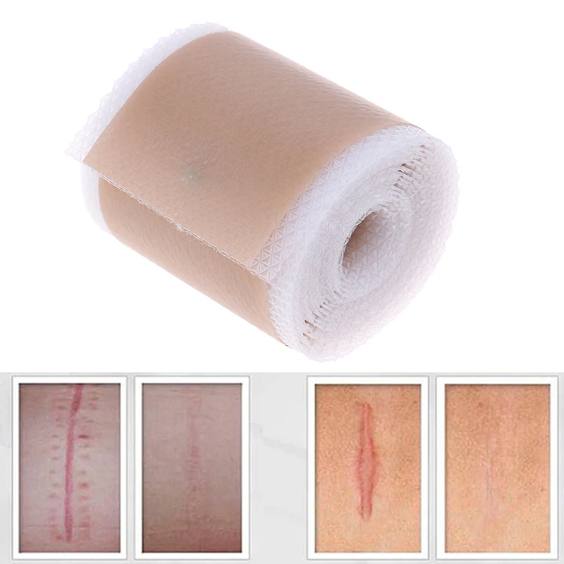Parche de Gel de silicona para la eliminación de cicatrices, Parche de terapia para acné, lesión, Reparación de la piel de cicatrices, 4x150cm